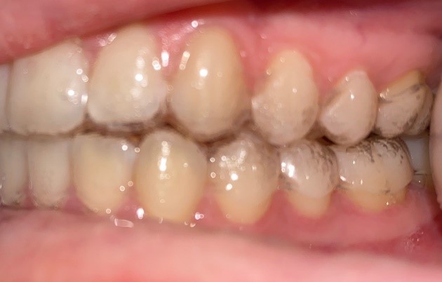 Virtual Appointment Photos - Left Side - Halgren Orthodontics